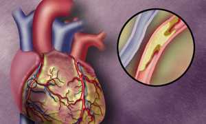 Атеросклеротический кардиосклероз