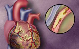 Атеросклеротический кардиосклероз
