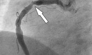 Коронография сердца — что это такое