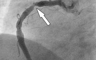 Коронография сердца — что это такое