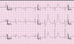 Осложнения инфаркта миокарда