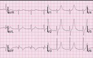 Осложнения инфаркта миокарда