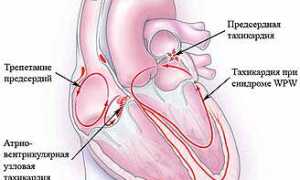 Учащенное сердцебиение причины