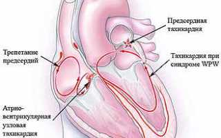 Учащенное сердцебиение причины