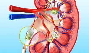 Реноваскулярная гипертензия