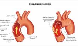 Расслоение аорты