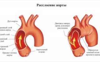 Расслоение аорты