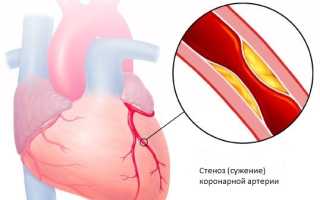 Лечение стенокардии народными средствами