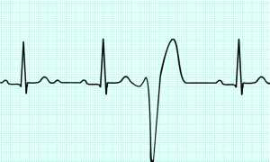 Лечение аритмии в Израиле
