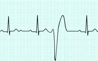 Лечение аритмии в Израиле