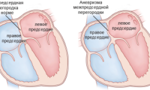 Аневризма межпредсердной перегородки