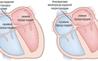 Аневризма межпредсердной перегородки