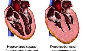 Гипертрофическая кардиомиопатия