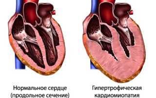 Гипертрофическая кардиомиопатия