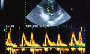 Диастолическая дисфункция левого желудочка