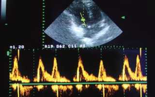 Диастолическая дисфункция левого желудочка