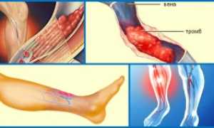 Тромбоз артерий нижних конечностей