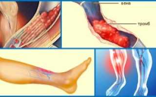 Тромбоз артерий нижних конечностей