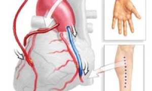 Шунтирование в Израиле