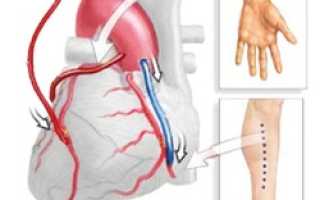 Шунтирование в Израиле