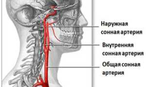 Аневризма сонной артерии