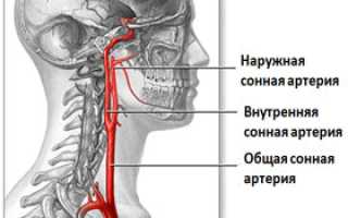 Аневризма сонной артерии