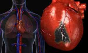 Постинфарктный кардиосклероз