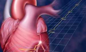 Нарушение работы сердца – последствие обширного инфаркта