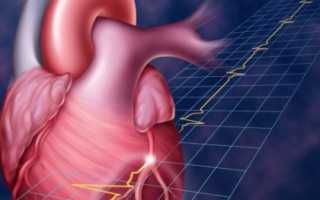 Нарушение работы сердца – последствие обширного инфаркта