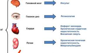 Гипертония 3 степени