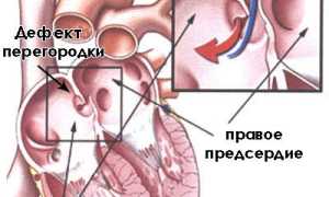 Дефект межпредсердной перегородки