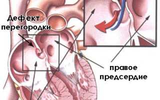 Дефект межпредсердной перегородки