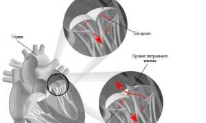 Пролапс митрального клапана