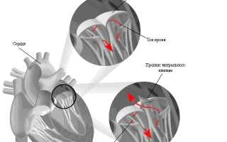 Пролапс митрального клапана