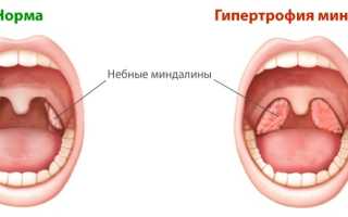 Питание и реабилитация после удаления миндалин