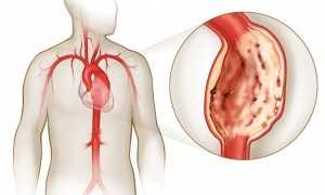 Аневризма сердца