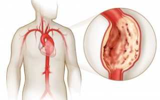 Аневризма сердца