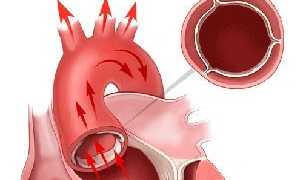 Уплотнение аорты – что это такое