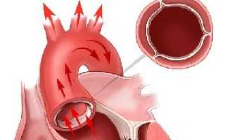 Уплотнение аорты – что это такое