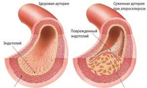 Коронарное шунтирование сосудов сердца