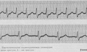 Пароксизмальная суправентрикулярная тахикардия