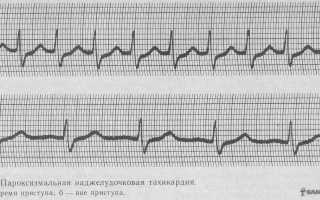 Пароксизмальная суправентрикулярная тахикардия