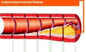 Церебральный атеросклероз