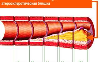 Церебральный атеросклероз