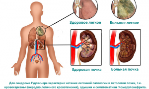 Синдром Гудпасчера