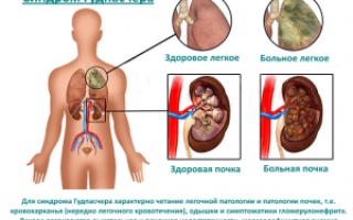 Синдром Гудпасчера