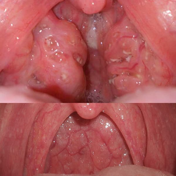 Когда можно есть после удаления миндалин