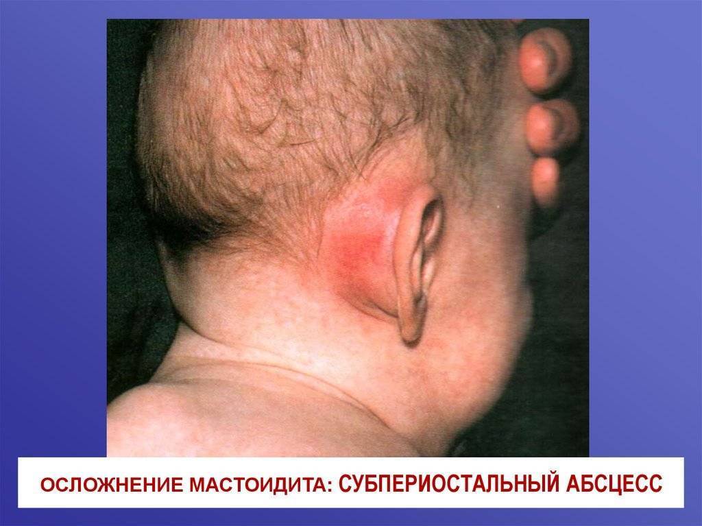 Мастоидит: причины, признаки, диагностика, как лечить, профилактика