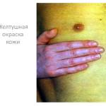 Признаки появления печеночного сосальщика у человека: симптомы и лечение
