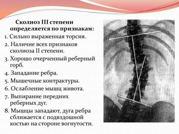 Идиопатический сколиоз грудопоясничного отдела позвоночника
